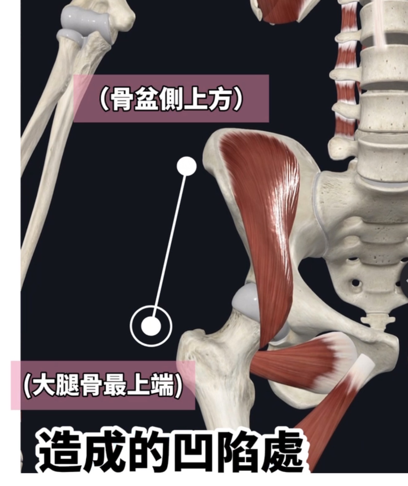 Hip Dip是髂股與股骨大轉子連結處產生的體態視覺特徵